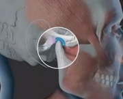 Distúrbio Temporo Mandibular (10)