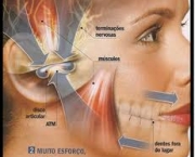 foto-disturbio-temporomandibular-10