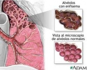 foto-enfisema-pulmonar-03