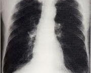 foto-enfisema-pulmonar-06