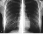 foto-enfisema-pulmonar-14