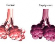 foto-enfisema-pulmonar-15