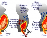 Eritroblastose Fetal (6)