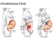 Eritroblastose Fetal (8)
