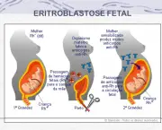 Eritroblastose Fetal (14)