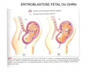 Eritroblastose Fetal (15)