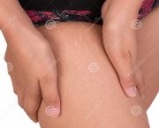 http://www.dreamstime.com/royalty-free-stock-image-stretch-marks-skin-thigh-women-image59329926