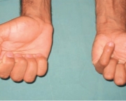 Flexor Superficial dos Dedos - Inervação (1)