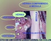 hernia-de-disco-como-surge-sintomas-e-tratamento-1