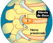 hernia-de-disco-como-surge-sintomas-e-tratamento-6
