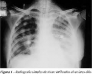 foto-insuficiencia-respiratoria-04