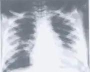 foto-manobra-de-reexpansao-pulmonar-15