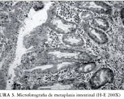 Metaplasia Intestinal - Sintomas (1)
