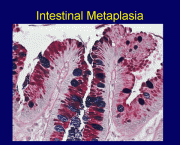 Metaplasia Intestinal - Sintomas (2)