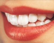 metodos-de-restauracao-dos-dentes-3