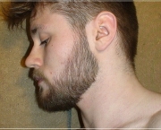 Minoxidil Para Crescimento de Barba - Efeitos Colaterais (3)