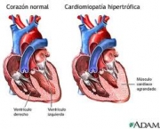 foto-miocardiopatia-hipertrofica-04