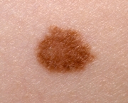 Skin mole