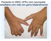 Neuropatia (11)