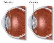 o-que-e-catarata-1