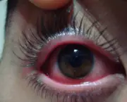 olho-seco-tratamento-e-sintomas-2