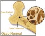 foto-osteoporose-11