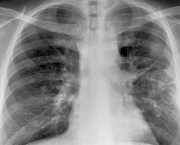 Pneumonia (10)