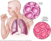 Pneumonia (13)