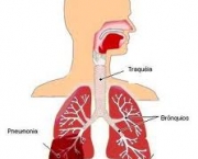 foto-pneumonia-10