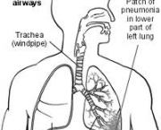 foto-pneumonia-11