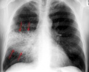 foto-pneumonia-13