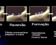 principais-sintomas-da-osteoporose-1