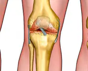 Healthy knee anatomy, degenerative arthritis of the knee and replacement surgery. Digital illustrati