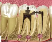 Restauração Dentária (1)