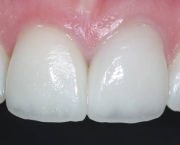Restauração Dentária (4)