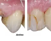 Restauração Dentária (5)