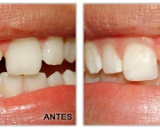 Restauração Dentária (7)