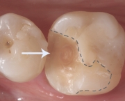 Restauração Dentária (10)