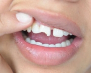 Restauração Dentária (9)