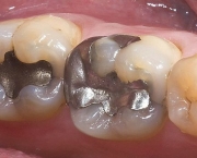 Restauração Dentária (13)