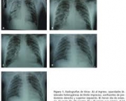 foto-sindrome-de-insuficiencia-respiratoria-aguda-04