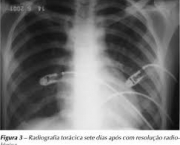 foto-sindrome-de-insuficiencia-respiratoria-aguda-06