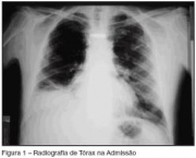 foto-sindrome-de-insuficiencia-respiratoria-aguda-10