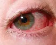 sindrome-do-olho-seco-o-que-e-e-como-evita-la-no-inverno-9