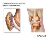 foto-sindrome-patelo-femoral-01