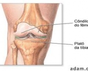 foto-sindrome-patelo-femoral-03