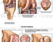 foto-sindrome-patelo-femoral-07