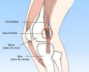 foto-sindrome-patelo-femoral-14