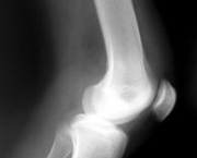 foto-sindrome-patelo-femoral-15