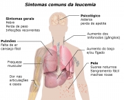 Sintomas e Tratamento da Leucemia (15)